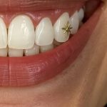 limpiar dientes con tooth gems
