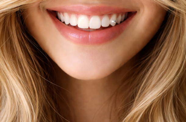 tooth gems en dientes delanteros o laterales