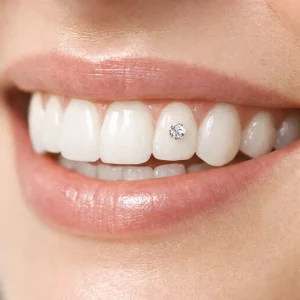tooth gems blanqueamiento dental