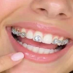 tooth gems y alimentos